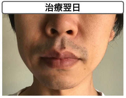 【ゴリラクリニックのヒゲ脱毛】治療した後、翌日まで跡は残るの？見た目の状態はどんな感じ？バレる心配はないか、徹底解説！
