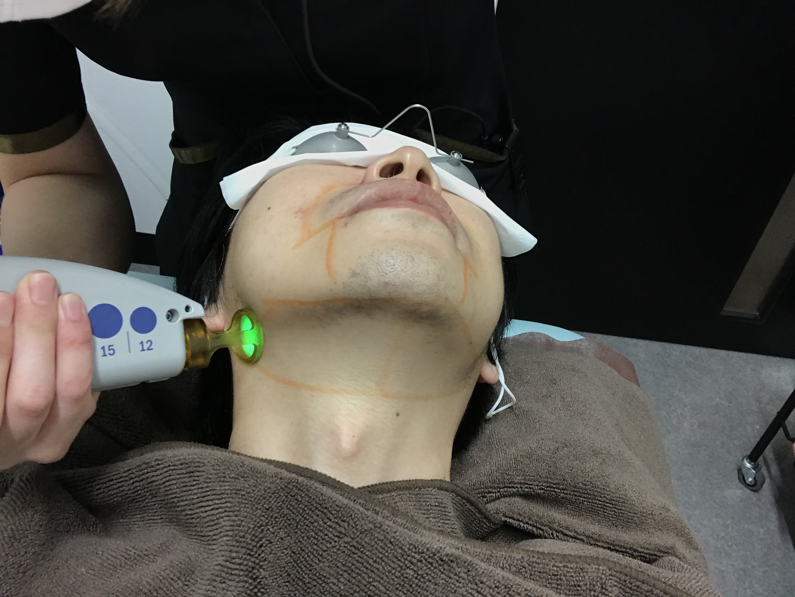 ゴリラ脱毛の前にヒゲは剃るべき?翌日は剃って良いの?施術前後の注意点を徹底解説!