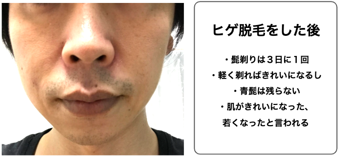 【体験談】ゴリラクリニックのヒゲ脱毛に１年間（６回）行った感想と評価
