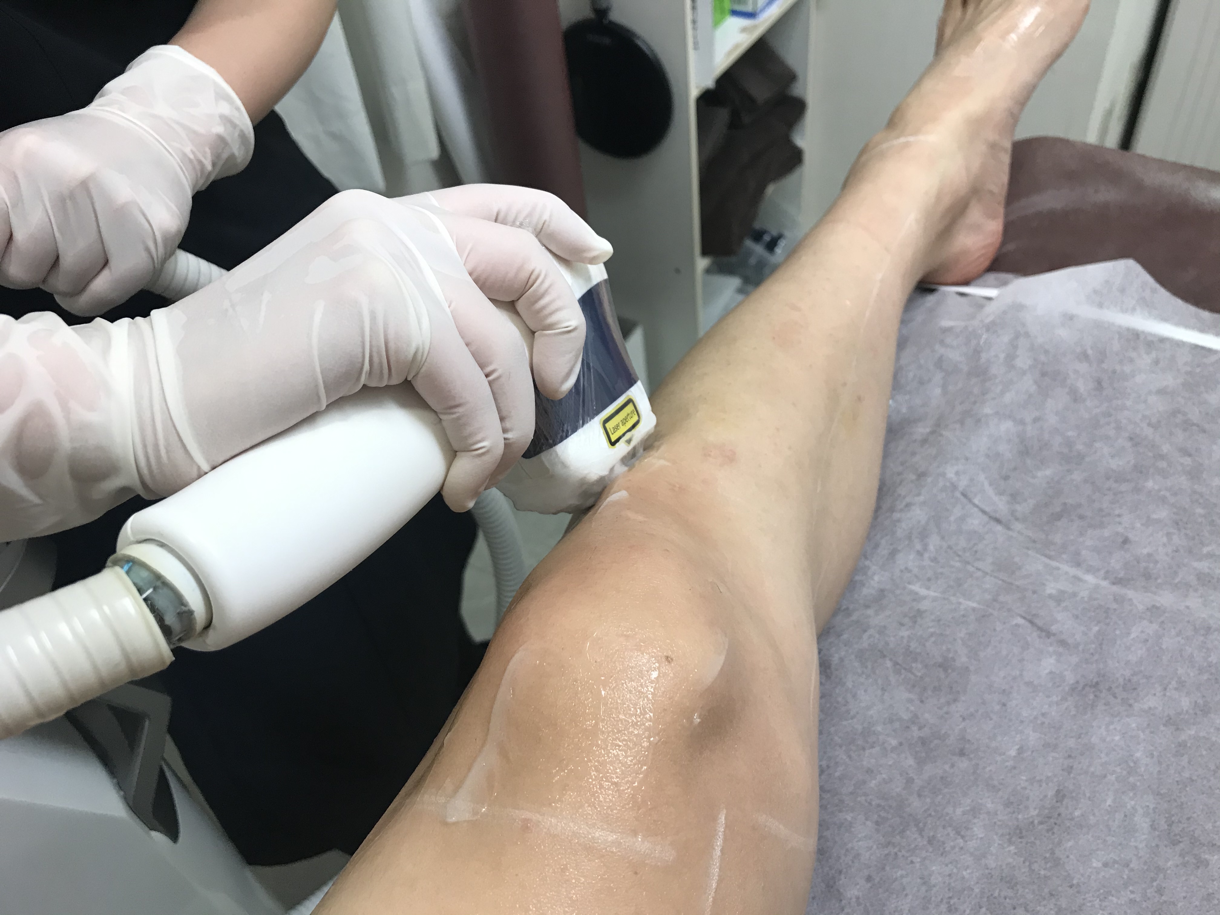 ゴリラクリニックでスネ毛、モモ毛、足指の毛を脱毛してみた！痛みや効果についてレポート！