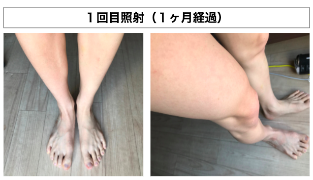 ゴリラクリニックでスネ毛、モモ毛、足指の毛を脱毛してみた！痛みや効果についてレポート！